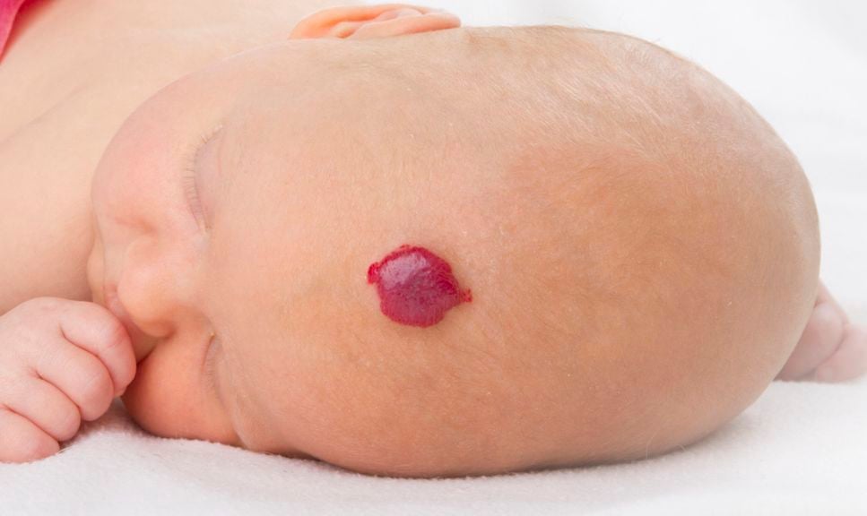 auf dem Bauch liegendes Baby, mit Hämangiom an der Stirne/Kopf, Storchenbiss
